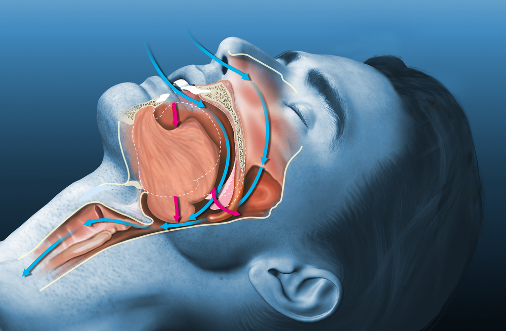 Medically,3d,illustration,shows,a,sleeping,snoring,man